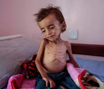 Malnutrition
